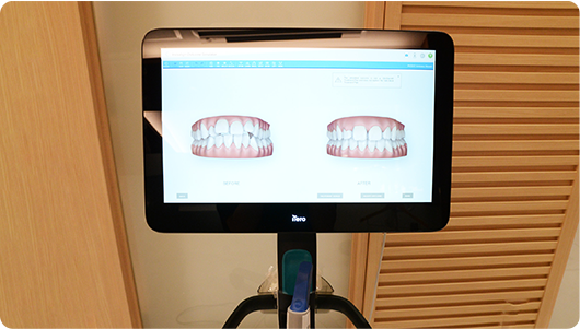 3Dシミュレーションソフト（クリンチェック）による歯の移動予測の画像
