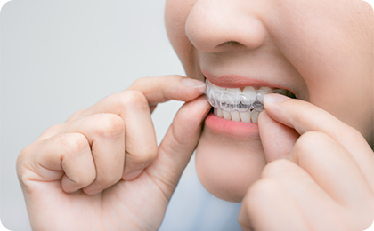 マウスピース装着の画像