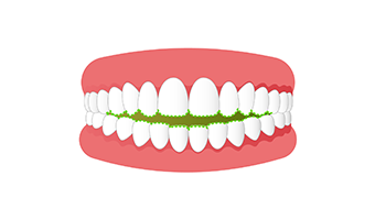 開咬（オープンバイト）の画像