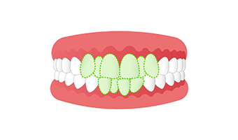 叢生（八重歯・乱ぐい歯）の画像