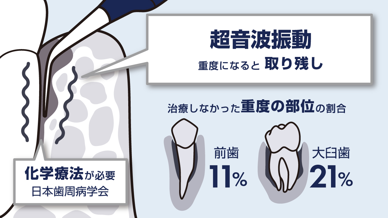 従来の歯周病治療は超音波振動による治療のみで、歯石の取り残しが生じていました。