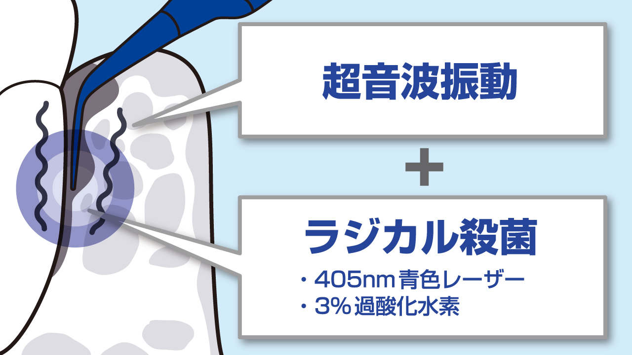 ブルーラジカルによる治療は、超音波振動による治療と、過酸化水素とレーザー照射によるラジカル殺菌技術を組み合わせた治療。